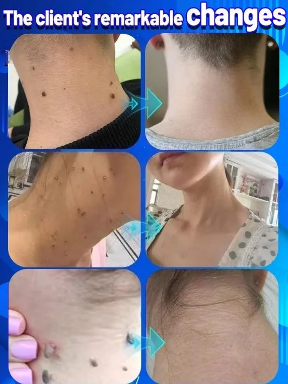 Cosmetic Skin Surface Care Device for Mole Spot Wart and Tag Support
