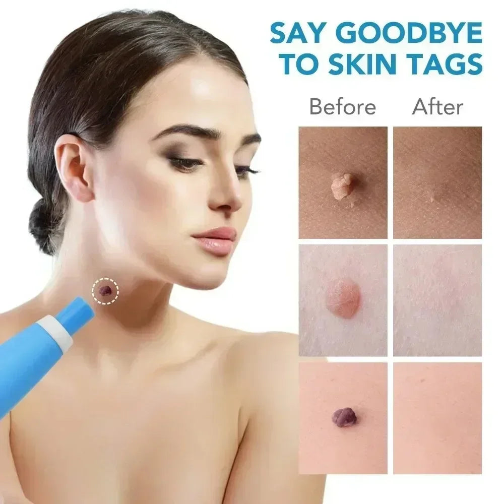 2 IN 1 Painless Auto Micro Skin Tag Removal Kit Adult Skin Tag Mole Wart Remover Device Face Cleaning Skin Care Beauty Tools