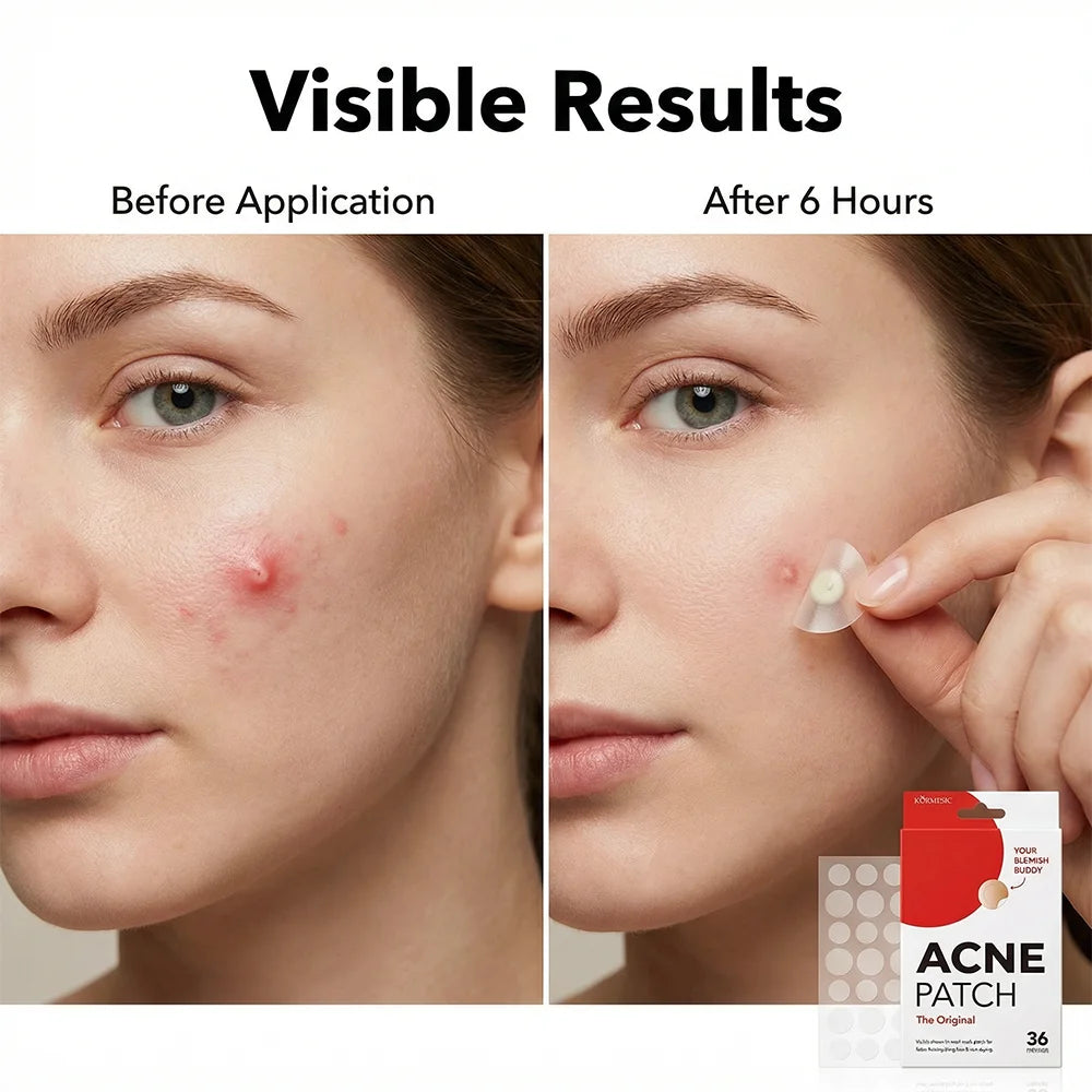 36Pcs Invisible Hydrocolloid Acne Patches, Pimple Zit Stickers for Face, Absorb Pus Oil Reduce Redness, All Day Blemish Cover