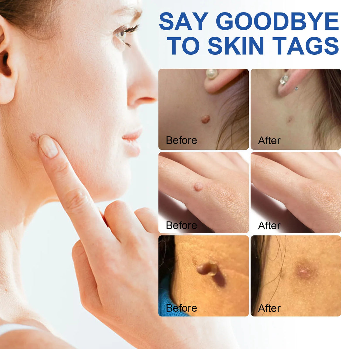 Auto Large Size Skin Tag Removal Tool Kit Painless Mole Wart Removal Pen Body Dot Treatments Remover Beauty Face Skin Care Tools