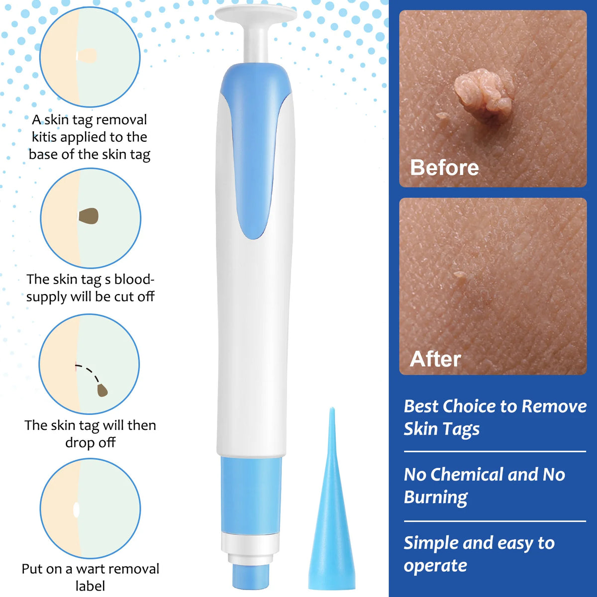 Auto Large Size Skin Tag Removal Tool Kit Painless Mole Wart Removal Pen Body Dot Treatments Remover Beauty Face Skin Care Tools